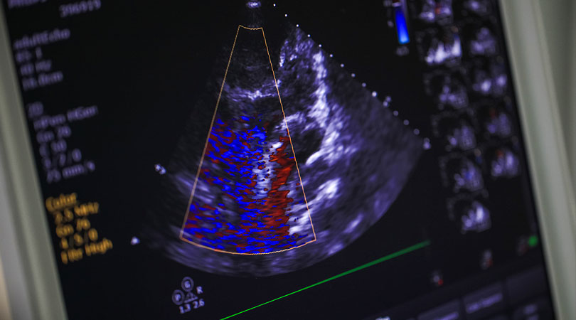 echocardiogram