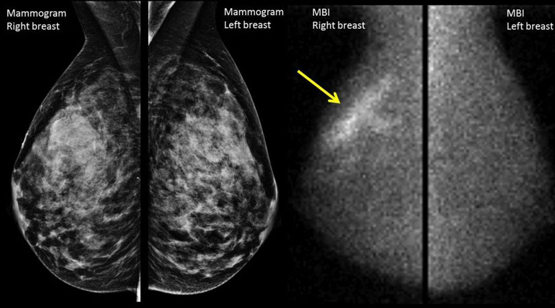 mammography